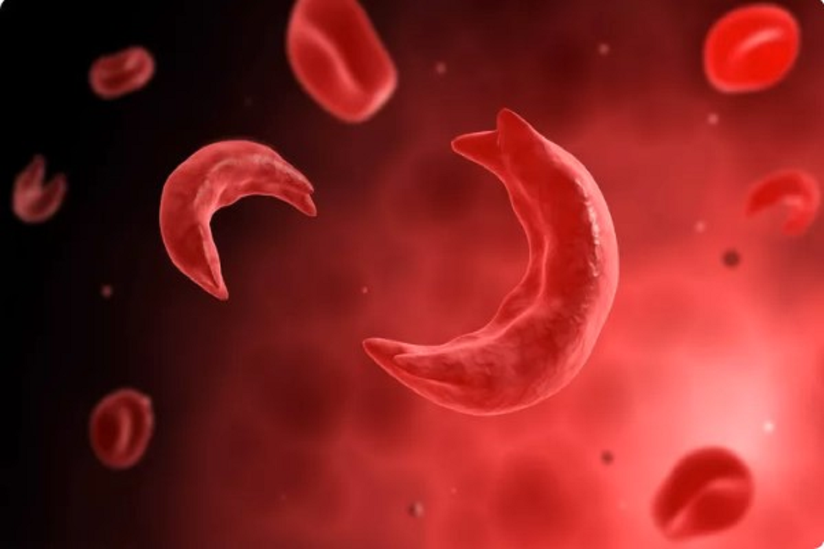 Mission to End Sickle Cell Anemia: سکیل سیل انیمیا کے خاتمےکا مشن