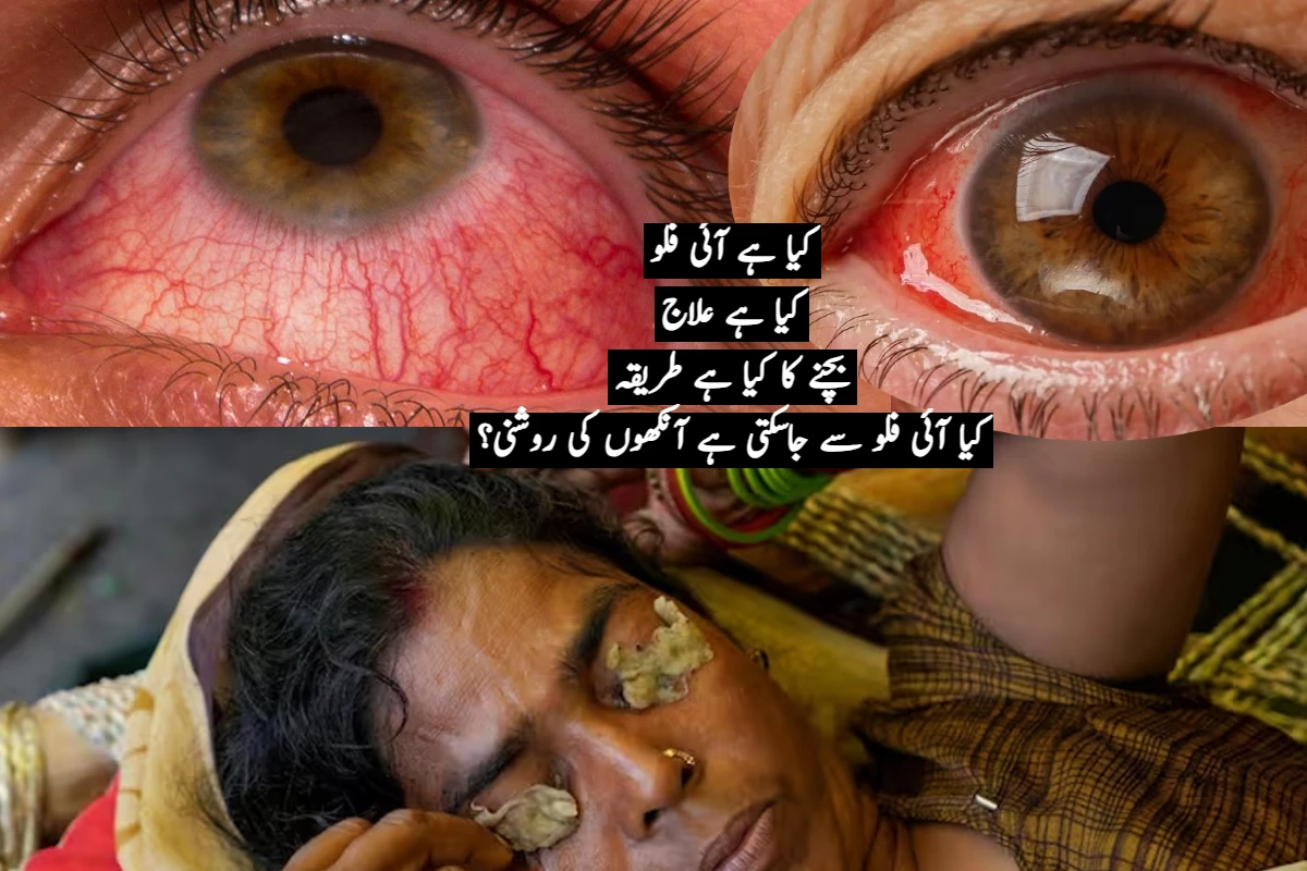 Eye flu symptoms and treatment: آئی فلو کے کیسز میں تیزی سے ہورہا ہے اضافہ، جانئے کیا ہے وجہ اور کیسے خود کو رکھ سکتے ہیں محفوظ