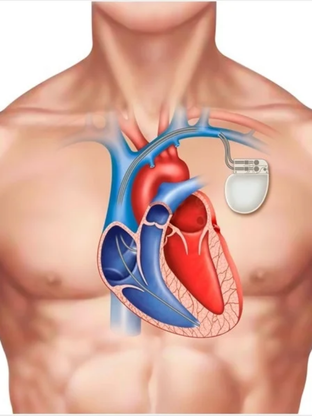 جانئے پیس میکر سرجری کے فوائد اور اس کی پیچیدگی