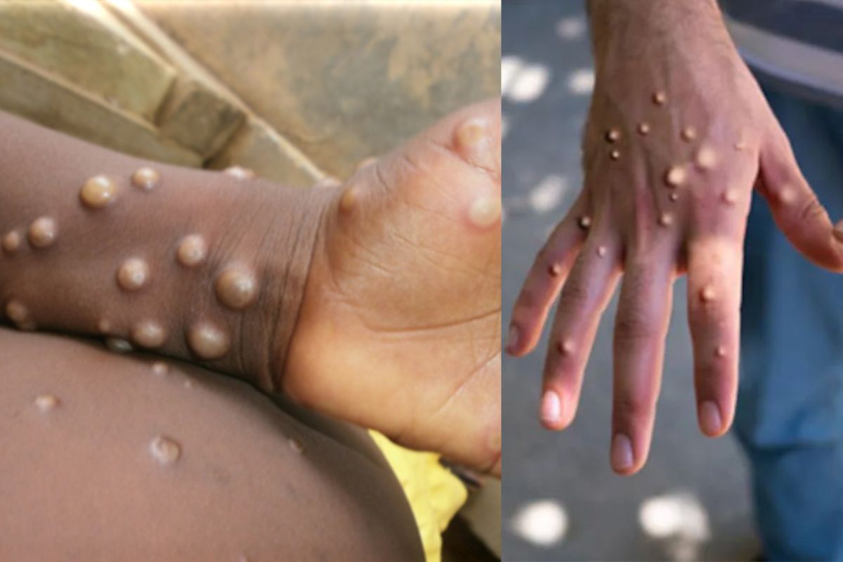 Monkeypox Virus Infection: بھارت میں بھی داخل ہوا منکی پوکس! بیرون ملک سے واپس آنے والے شخص میں پائی گئی علامات